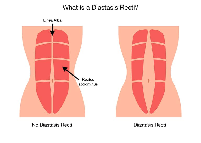 Can I exercise with a diastasis recti?