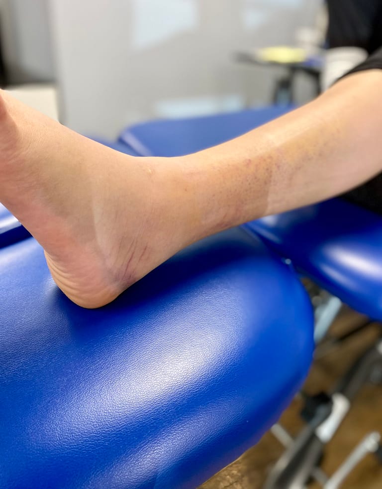 Ankle Sprains: What You Need to Know